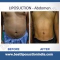 What is the benefits and limitations of Liposuction?
