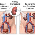 Kidney Transplant Journey in India Can Give You the Gift of Life
