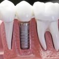 How Strong Are Dental Implants Compared To Natural Teeth?