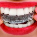 What are the Important Things To Know In Choosing Invisalign Brace in Brickell, Florida?