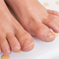 Learn about the types of fungal nail infection and how to prevent it