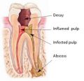 The Endodontic Procedure