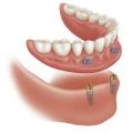 Implant Denture and Dental Center