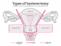 Uterus Removal (Hysterectomy)