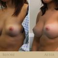 3 Important Questions about Breast Augmentation Answered by Cosmetic Surgery South Wales