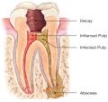 Get Root Canal Treatment Done to Correct Your Dental Flaws