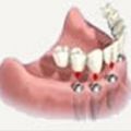 Get Rid of Missing Teeth with the Best Dental Implants