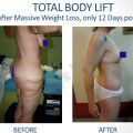 Body Lift Surgery – How is the procedure performed?