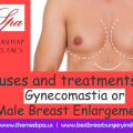 Causes and treatments of Gynecomastia or Male Breast Enlargement