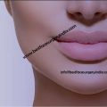 Lip Reduction – Do you have large lips?