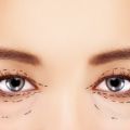 Is blepharoplasty surgery right for you?