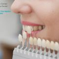 Let Dental Implants in San Diego Correct Your Teeth