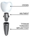 Maintain a Good Oral Health with Implants San Diego