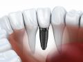 Let Implants San Diego Beautify Your Teeth
