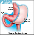 Sleeve Gastrectomy surgery