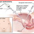 Pocket-Friendly Laparoscopic Hysterectomy Surgery in India