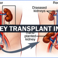 A global patient from Iraq goes ga-ga over having his low cost kidney transplant India