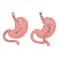 What to Know About Long-Term Care after Gastric Bypass Surgery