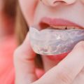 7 Benefits of Wearing a Sports Mouthguard