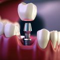 The 6 Fun Facts About Dental Implants