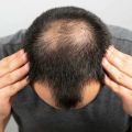 5 Hair Transplant Myths and Facts