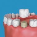 Debunking 10 Myths About Dental Crowns