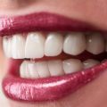 5 Reasons Why Replacing Your Missing Teeth with Dental Implants Is Worth It