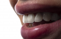 Who Is a Candidate For Gum Contouring?