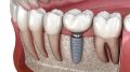 Possible Problems With Dental Implants