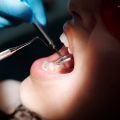 What Is the Lifespan of Dental Fillings?