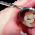 7 Myths About Treating Tooth Decay That You Should Stop Believing