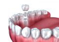 Pros and Cons of Mini Dental Implants