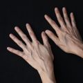 Bulging Hand Veins: Causes and Treatment Options