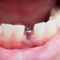 Essential Things to Know About Bone Graft