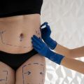 Things to Know to Become Prepared for Tummy Tuck