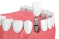 Advantages of Single Tooth Dental Implants