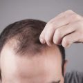 Top 10 Benefits of Getting a Hair Transplant
