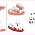 4 Common Types of Dental Bridges