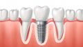 7 Reasons Dental Implants Often Feel More Natural Than People Expect