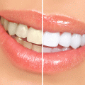 Teeth-Staining FAQ’s in Gables, FL