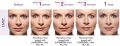 Cosmetic botox and fillers