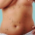 Get Your Body Back in Shape with Abdominoplasty or Liposuction Procedure in Aventura, Florida