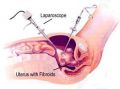 Hysterectomy · Fibroids Removal Specialist