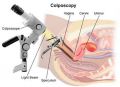 Colposcopy, Cervical Biopsy
