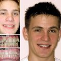 Brooklyn Teen Invisalign Treatment