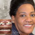 Dental implant (Free consultation)