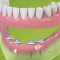 Mini Dental Implants NYC