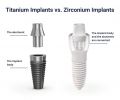 Titanium vs Zirconia Dental Implants