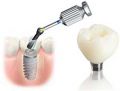 Benefits, Problems of Dental Bridge, Partial/Full Denture