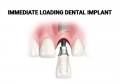 Immediate Load Dental Implants